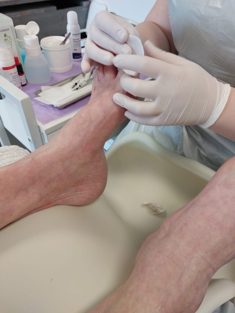 medisch pedicure behandeling