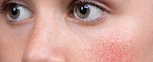 rosacea behandeling