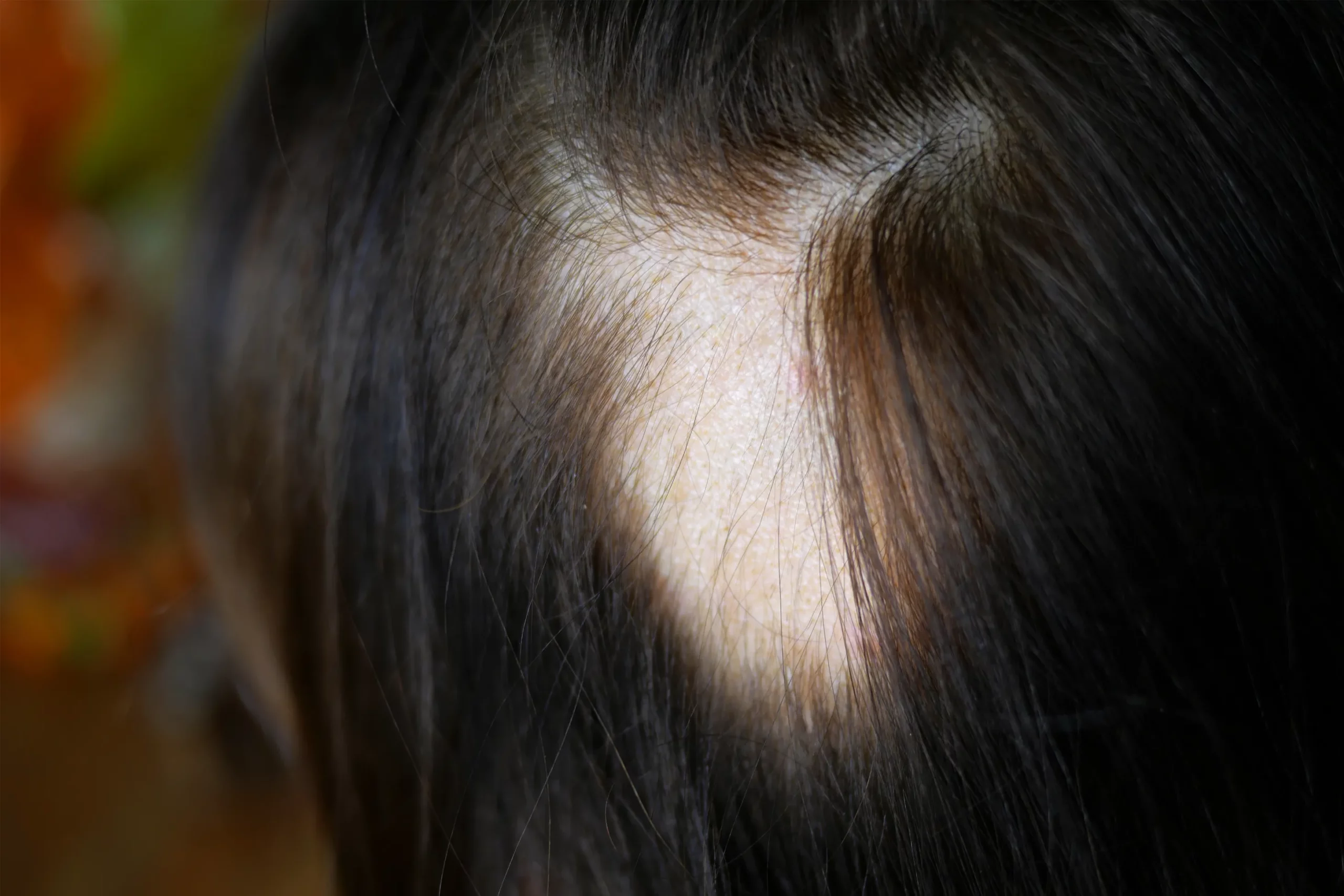 alopecia achterhoofd