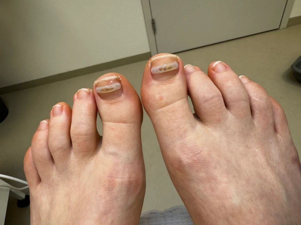 Nagelbeugels bij huidkliniek zaia